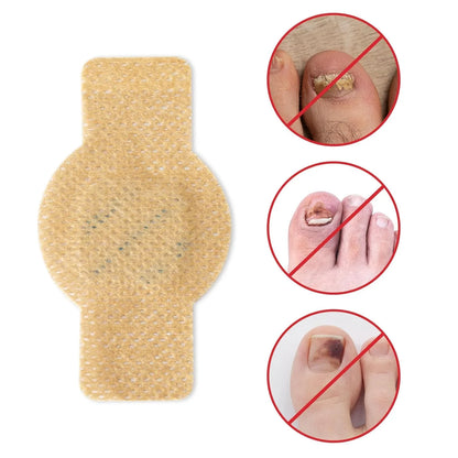 NailHeal™ - Fungal Nail Patches 🌿💅 ( Buy 1 Get 1 Free🔥🔥) with Free Spray