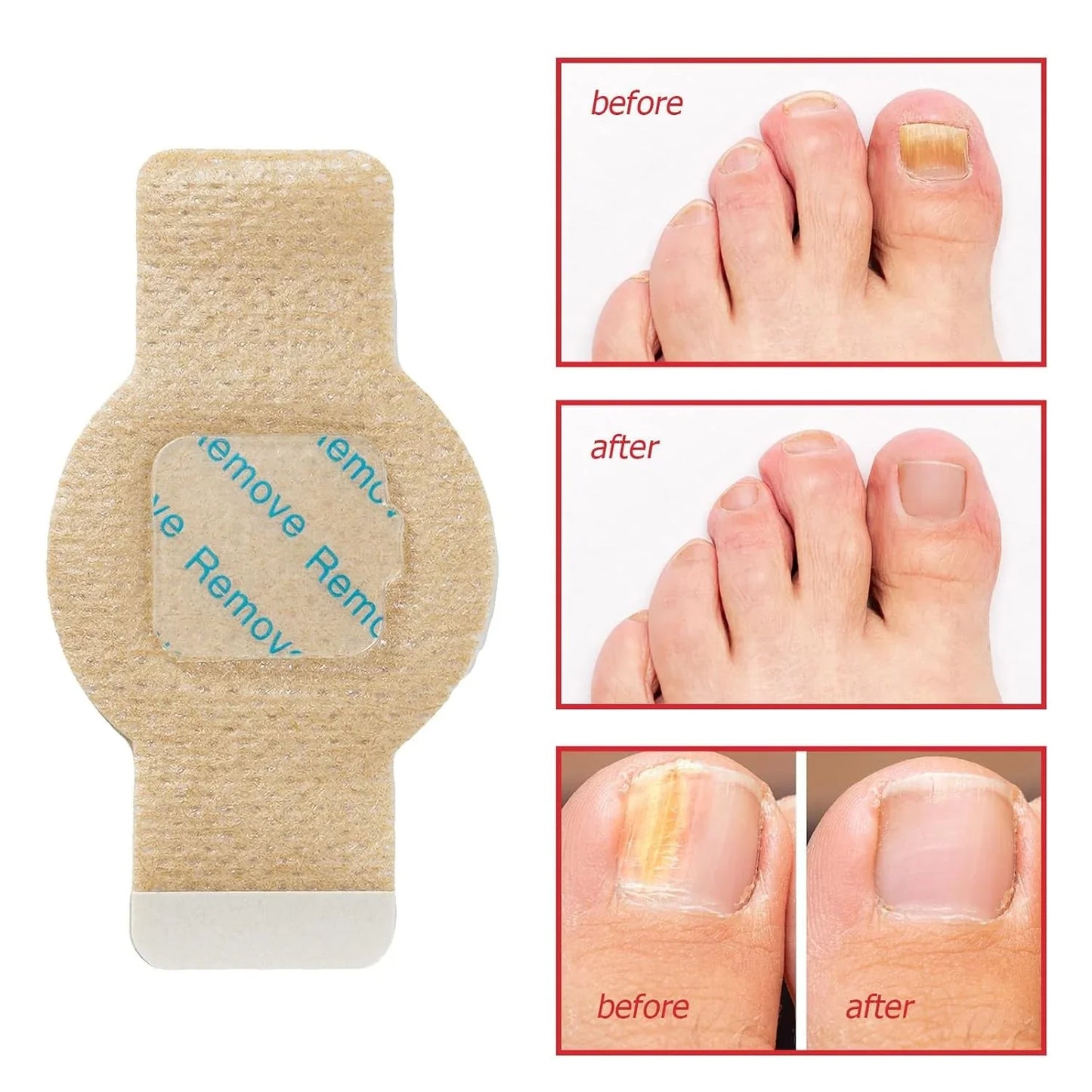 NailHeal™ - Fungal Nail Patches 🌿💅 ( Buy 1 Get 1 Free🔥🔥) with Free Spray