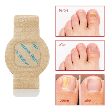 NailHeal™ - Fungal Nail Patches 🌿💅 ( Buy 1 Get 1 Free🔥🔥) with Free Spray